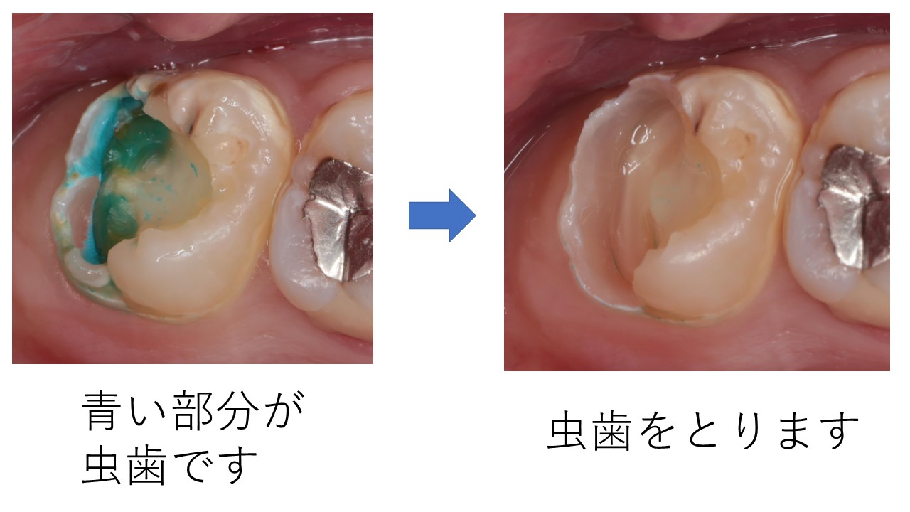 神経を抜かない虫歯治療 ｍｔａセメント 船橋駅３分の歯医者 川手歯科医院